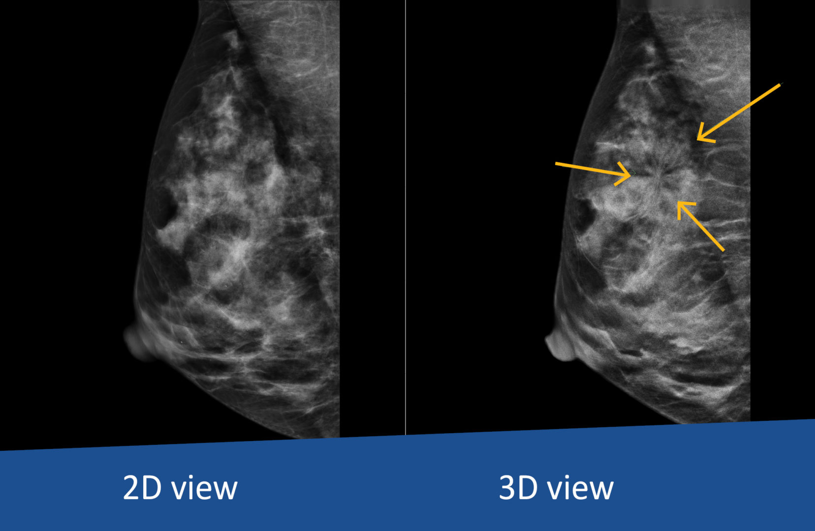 Comparison of 2D against 3D mammography of breast at Jones Radiology