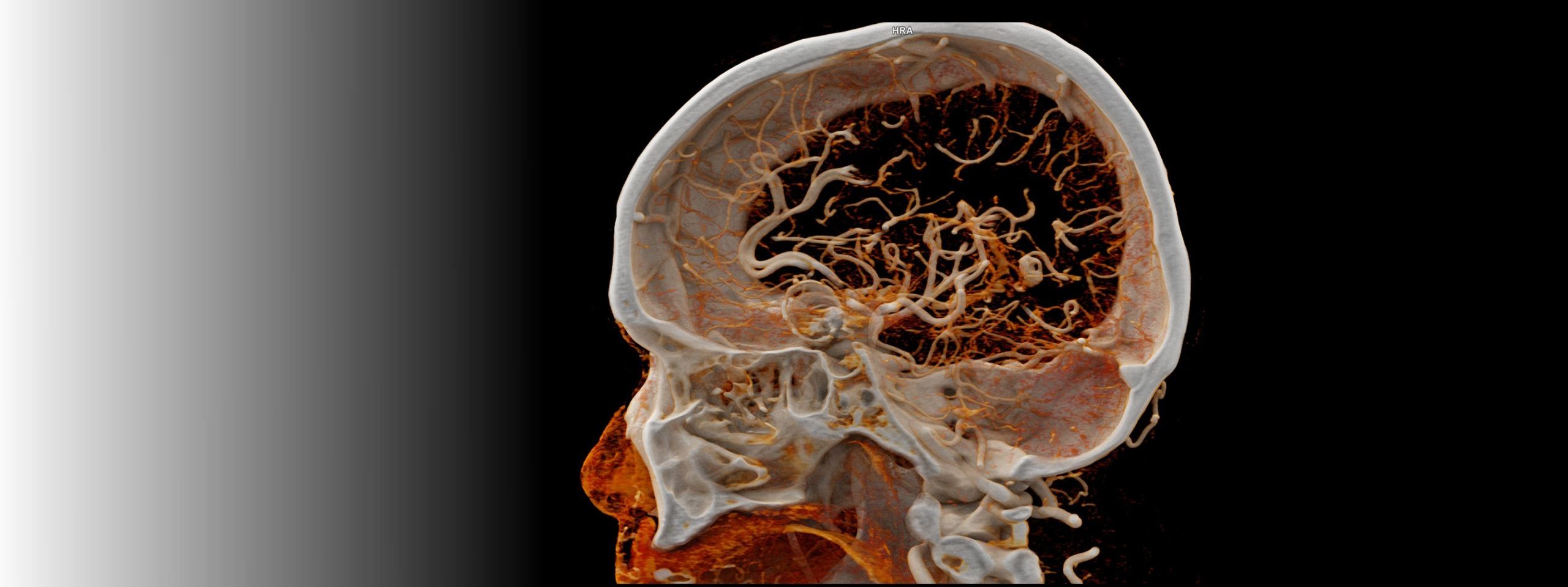 Clinical image of head using Australia's first photon counting CT (PCCT) machine at SAHMRI clinic (courtesy of Erasmus Medical Center, Rotterdam NL)